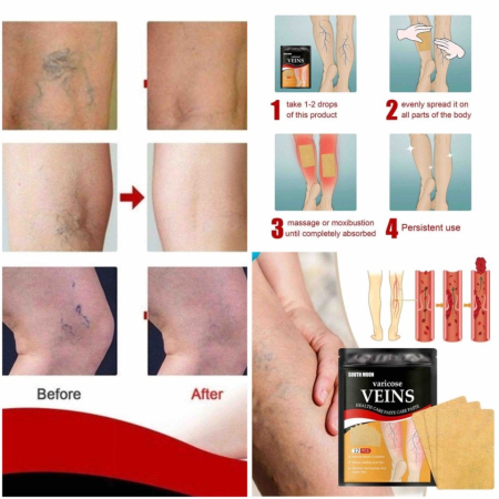 Plastrów do Usuwania Żylaków